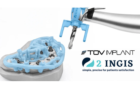 Guided Implant Surgery: Key Steps with 2INGIS